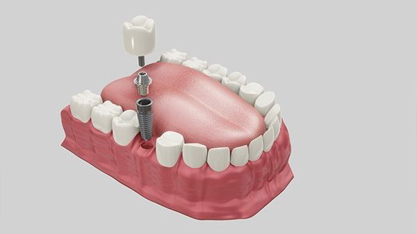 Dental Implants vs Bridges