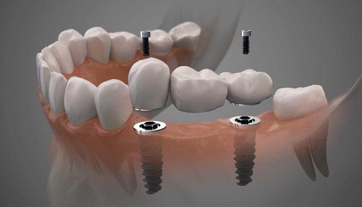 Dental Implants