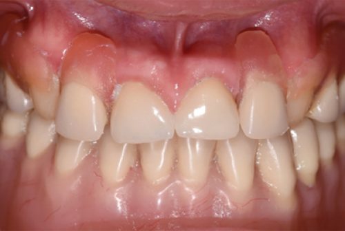 Prosthodontic Rehabilitation
