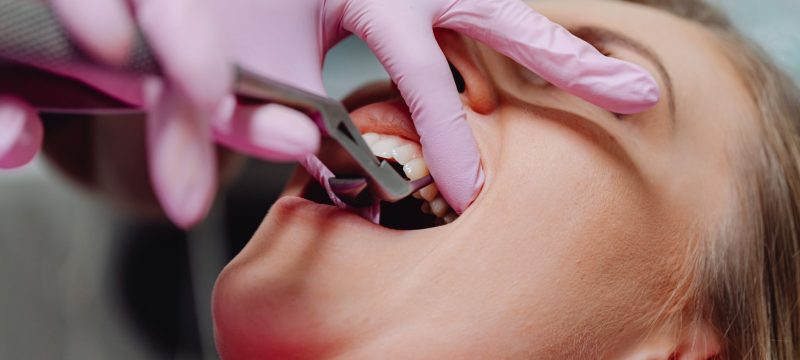 Tooth_Extraction_001 Tooth_Extraction_001