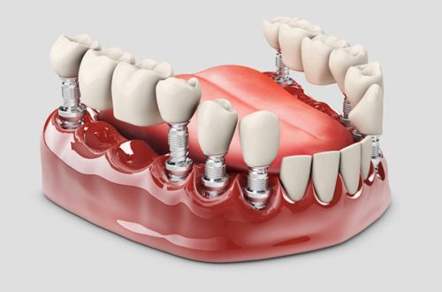 difference-between-crown-and-bridge-procedures
