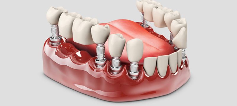 difference-between-crown-and-bridge-procedures