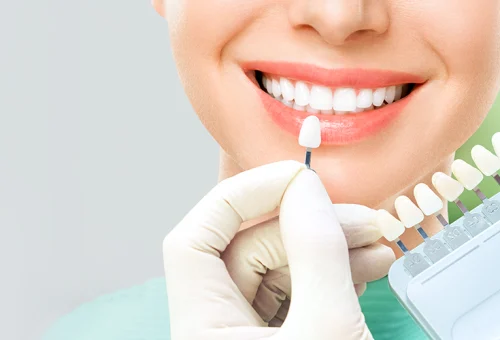 veneers